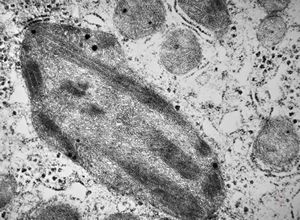 M,15y. | megamitochondria with lamellar inclusions in hepatocyte - Wilson disease